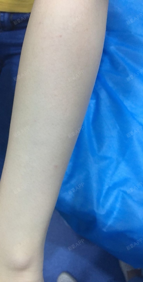 洁白如玉脱手臂第1天美丽日记-新氧美容整形