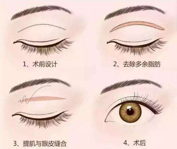 单眼皮,眼睛小,显得整个人没精神,做双眼皮有用