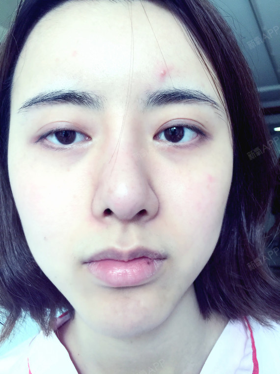 这张是手术前的照片,下巴旁边很凹吧,还有脸上那痘,美颜力度
