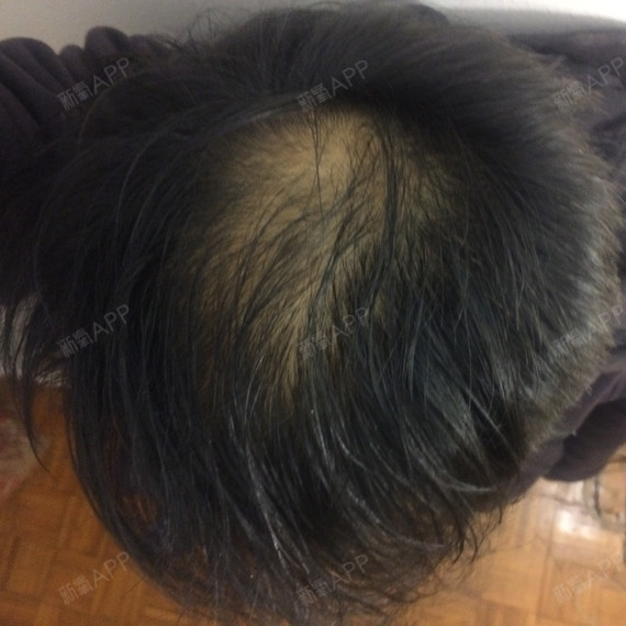 KeithJ种植发际线第0天美丽日记-新氧美容整形