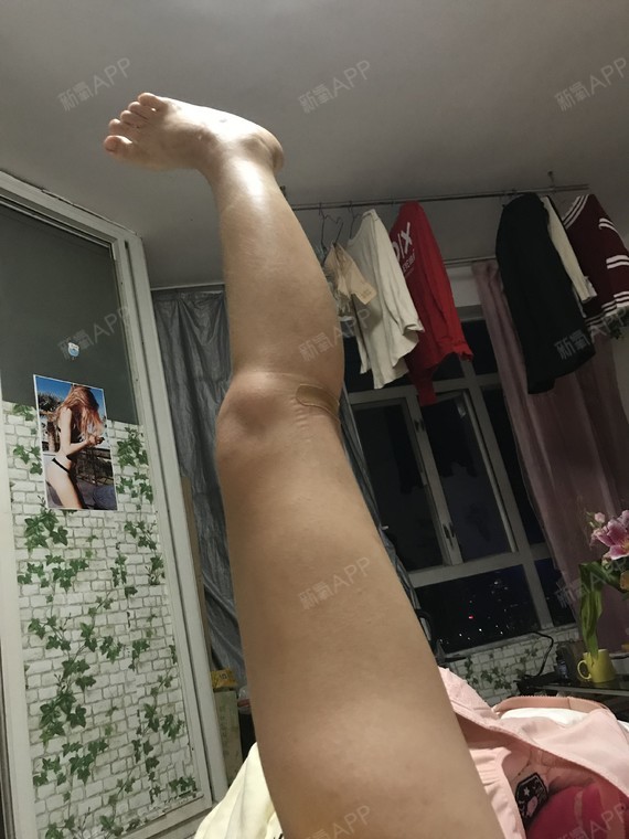 胖胖的小蜜蜂吸脂瘦小腿术后第26天美丽日记_新氧整形