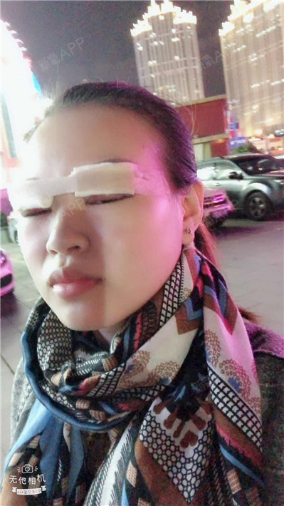 1别低头开内眼角第1天美丽日记-新氧美容整形