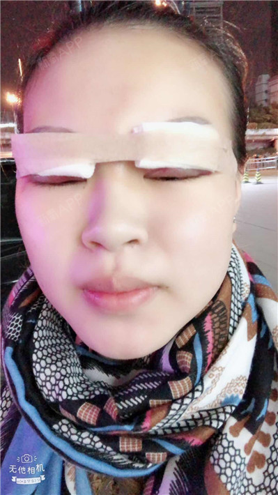 1别低头开内眼角第1天美丽日记-新氧美容整形