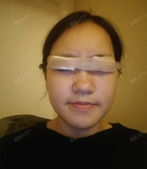 1万丈光芒全是我开内眼角第1天美丽日记-新氧