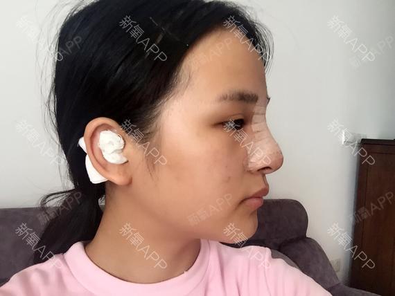 噼里啪啦滋滋滋鼻综合第1天美丽日记-新氧美容