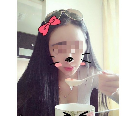 上海虹桥医院皮肤科肉毒素去狐臭第7天美丽日