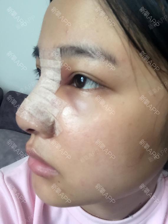 噼里啪啦滋滋滋鼻综合第1天美丽日记-新氧美容