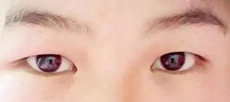 肿眼泡主要有两种