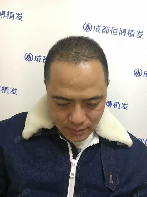 成都恒博植发种植头顶毛发第365天美丽日记-新