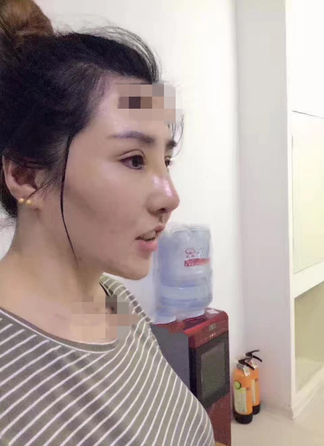 下眼下至术第4天