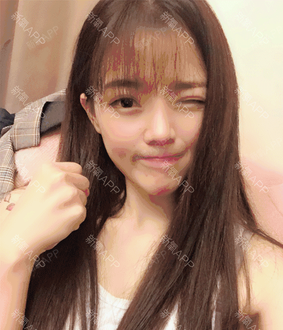 新氧- 陌陌陌凉 | 鼻部 | 隆鼻 | 术后当自强 | 天津同城 | 鼻部综合