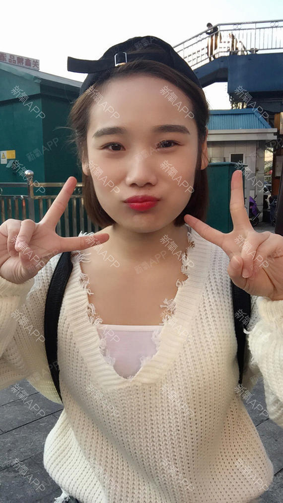 Iseeyou切开双眼皮第130天美丽日记-新氧美容