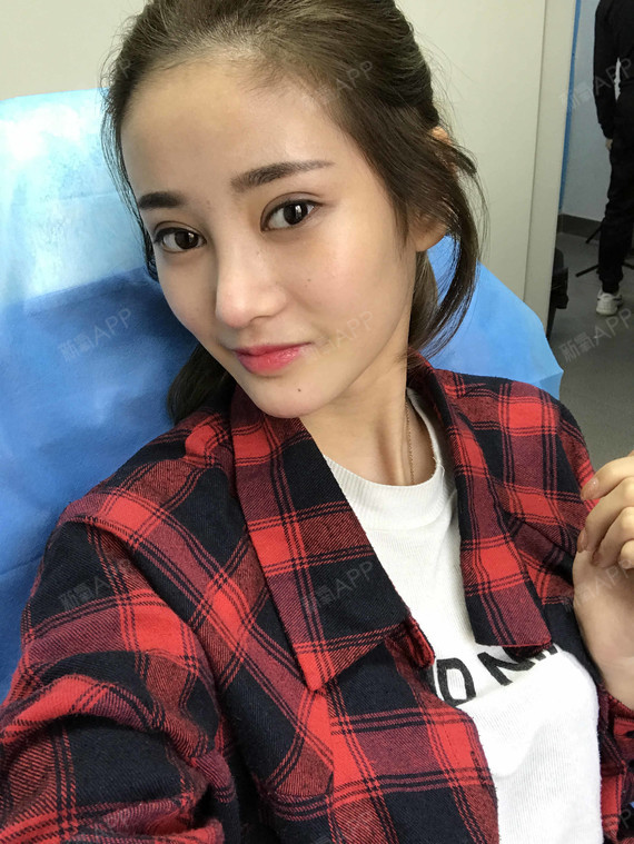 奎妮玻尿酸垫下巴第0天美丽日记-新氧美容整形