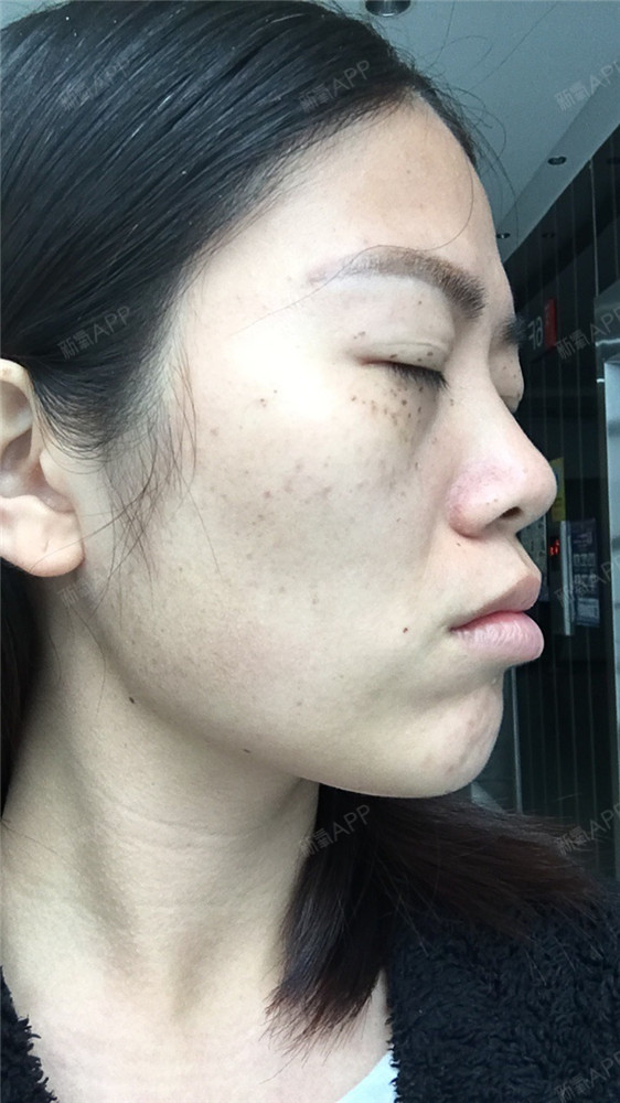 从未离开过激光祛斑第2天美丽日记-新氧美容整