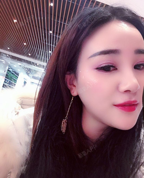 美琳娜开内眼角第214天美丽日记-新氧美容整形