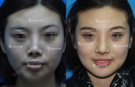 挛缩鼻修复,该患者由于外伤,假体取出后鼻_圈