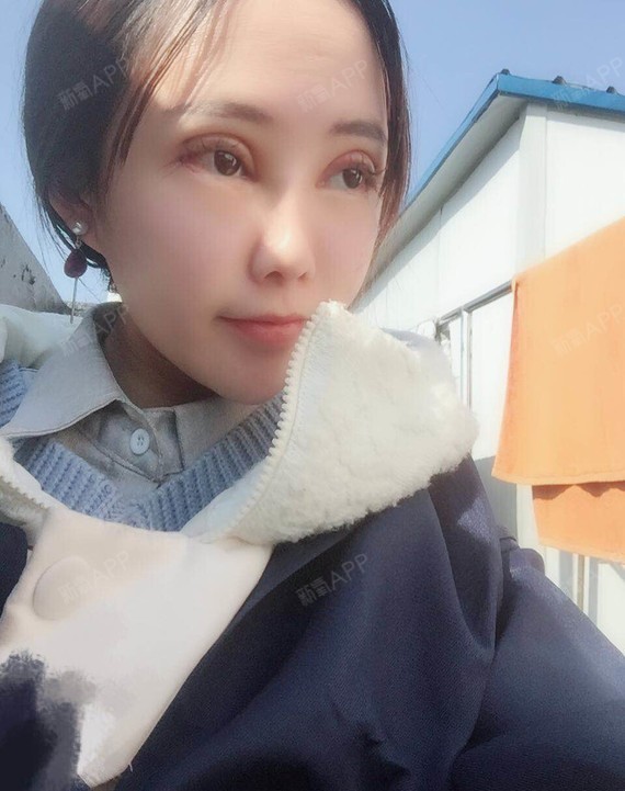 之后的恢复应该也会挺好的,其实我是做了一个眼综合,除了双眼皮,我还