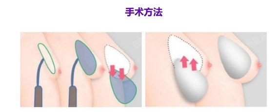 新氧 - 新氧韩国服务站 | 胸部 | 隆胸 | 乳头 | 乳房缩小 | 去副乳 | 假体隆胸 | 乳头整形 | 自体脂肪隆胸 | 吸脂去副乳 | 胸部修复 | 韩国整形 | 乳晕 | 乳晕漂红 | KOREA医生面对面 | 乳晕缩小 | 组团儿一起去韩国 新氧 - 新氧韩国服务站 | 胸部 | 隆胸 | 乳头 | 乳房缩小 | 去副乳 | 假体隆胸 | 乳头整形 | 自体脂肪隆胸 | 吸脂去副乳 | 胸部修复 | 韩国整形 | 乳晕 | 乳晕漂红 | KOREA医生面对面 | 乳晕缩小 | 组团儿一起去韩国