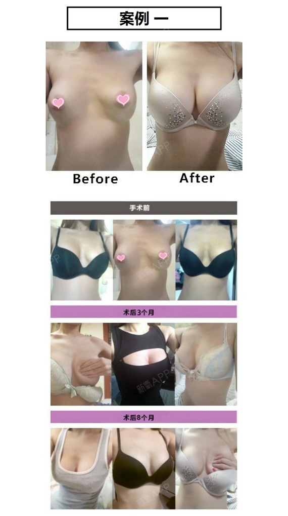 新氧 - 新氧韩国服务站 | 胸部 | 隆胸 | 乳头 | 乳房缩小 | 去副乳 | 假体隆胸 | 乳头整形 | 自体脂肪隆胸 | 吸脂去副乳 | 胸部修复 | 韩国整形 | 乳晕 | 乳晕漂红 | KOREA医生面对面 | 乳晕缩小 | 组团儿一起去韩国 新氧 - 新氧韩国服务站 | 胸部 | 隆胸 | 乳头 | 乳房缩小 | 去副乳 | 假体隆胸 | 乳头整形 | 自体脂肪隆胸 | 吸脂去副乳 | 胸部修复 | 韩国整形 | 乳晕 | 乳晕漂红 | KOREA医生面对面 | 乳晕缩小 | 组团儿一起去韩国