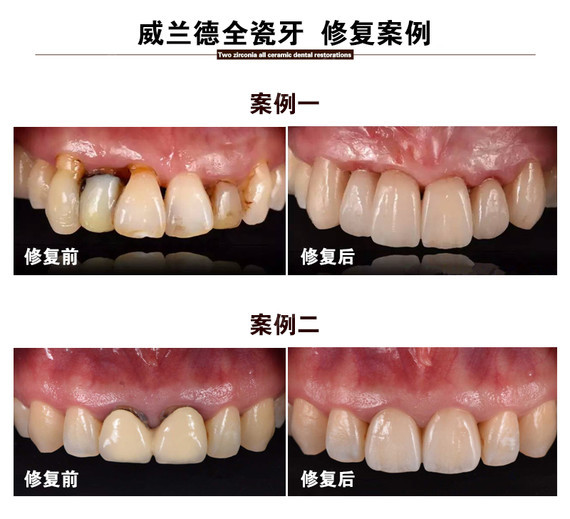 【全瓷牙】德国威兰德全瓷牙