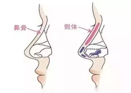 将假体放置到鼻背筋膜以下 让假体盖上厚厚的组织 预防透光还避免移位