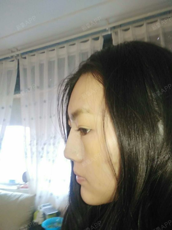 考不上大学去抗日硅胶隆鼻第2天美丽日记-新氧