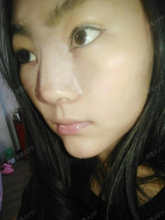 考不上大学去抗日硅胶隆鼻第2天美丽日记-新氧