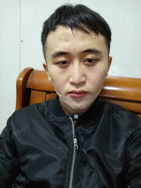 非常完美123硅胶垫下巴第1天美丽日记-新氧美