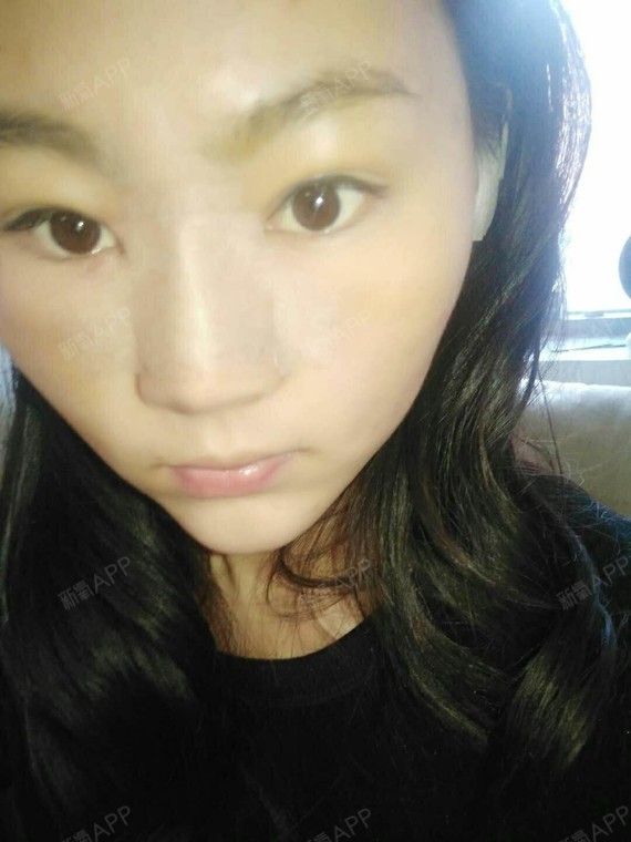 考不上大学去抗日硅胶隆鼻第2天美丽日记-新氧