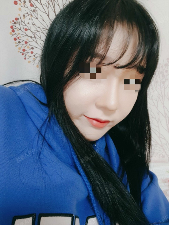 上海模特经纪TF鼻综合第35天美丽日记-新氧美