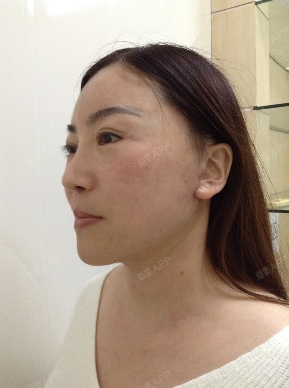 这是我做完手术的一个月复查照片~各位宝宝们你们看,做完拉皮后的我是
