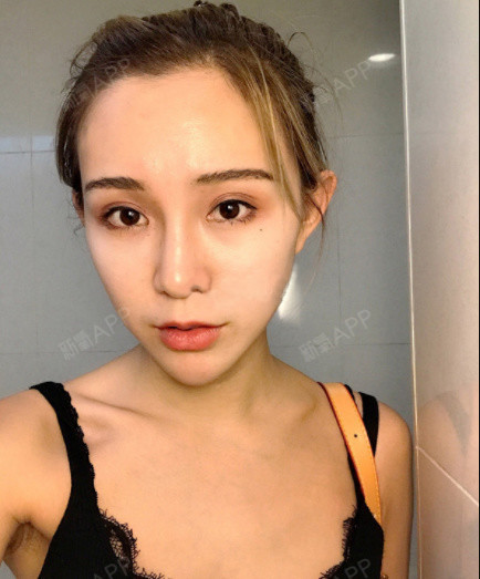 金华丽都整形:余医生肉毒素瘦脸第122天美丽日