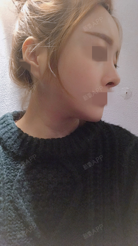 v-line瓜子脸手术