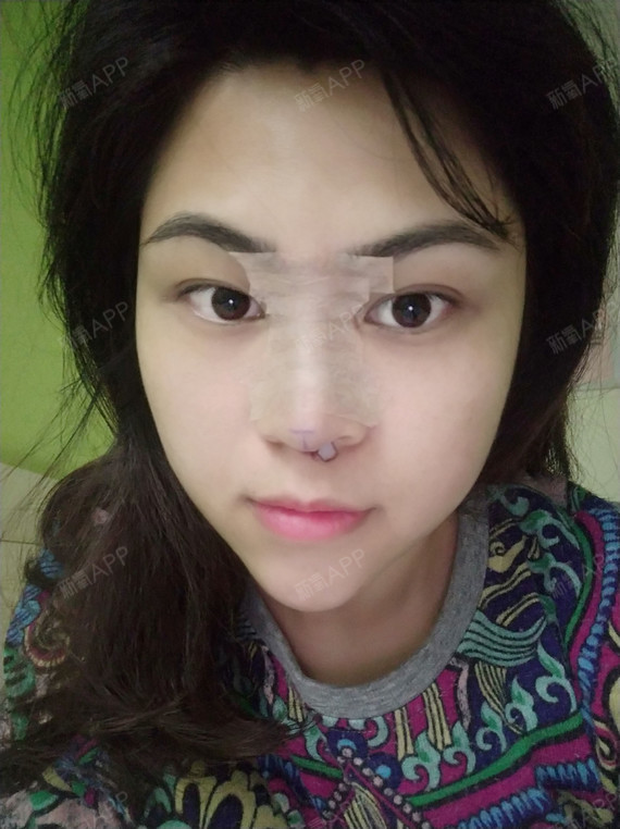 爱星星的孩子鼻综合第0天美丽日记-新氧美容整