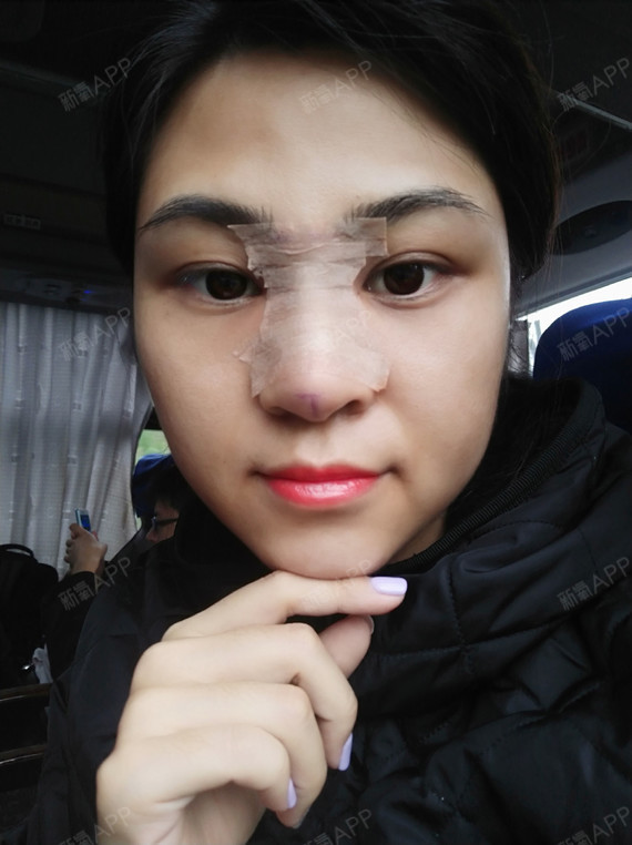 爱星星的孩子鼻综合第0天美丽日记-新氧美容整