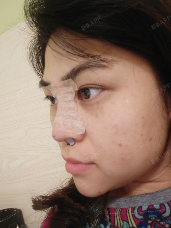 爱星星的孩子鼻综合第0天美丽日记-新氧美容整