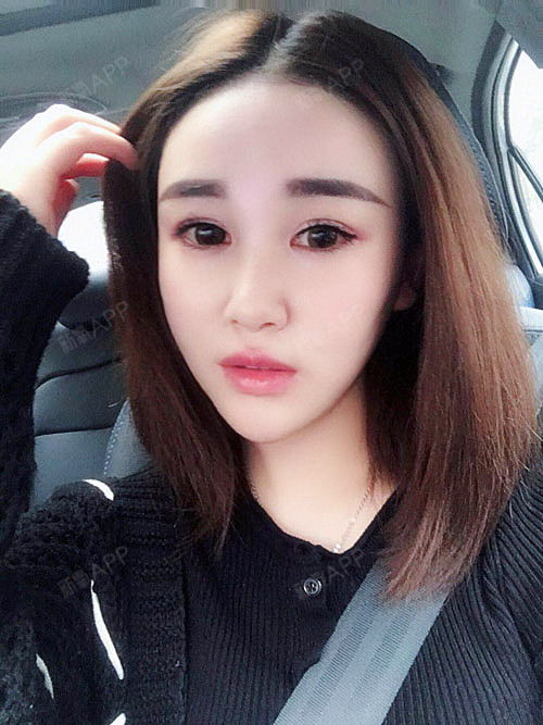 美琳娜开内眼角第251天美丽日记-新氧美容整形