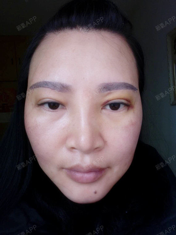 取名字好麻烦哦膨体垫下巴第7天美丽日记-新氧