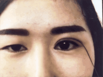 (郑州美莱)同样是双眼皮,为什么别人比你的好看100倍?