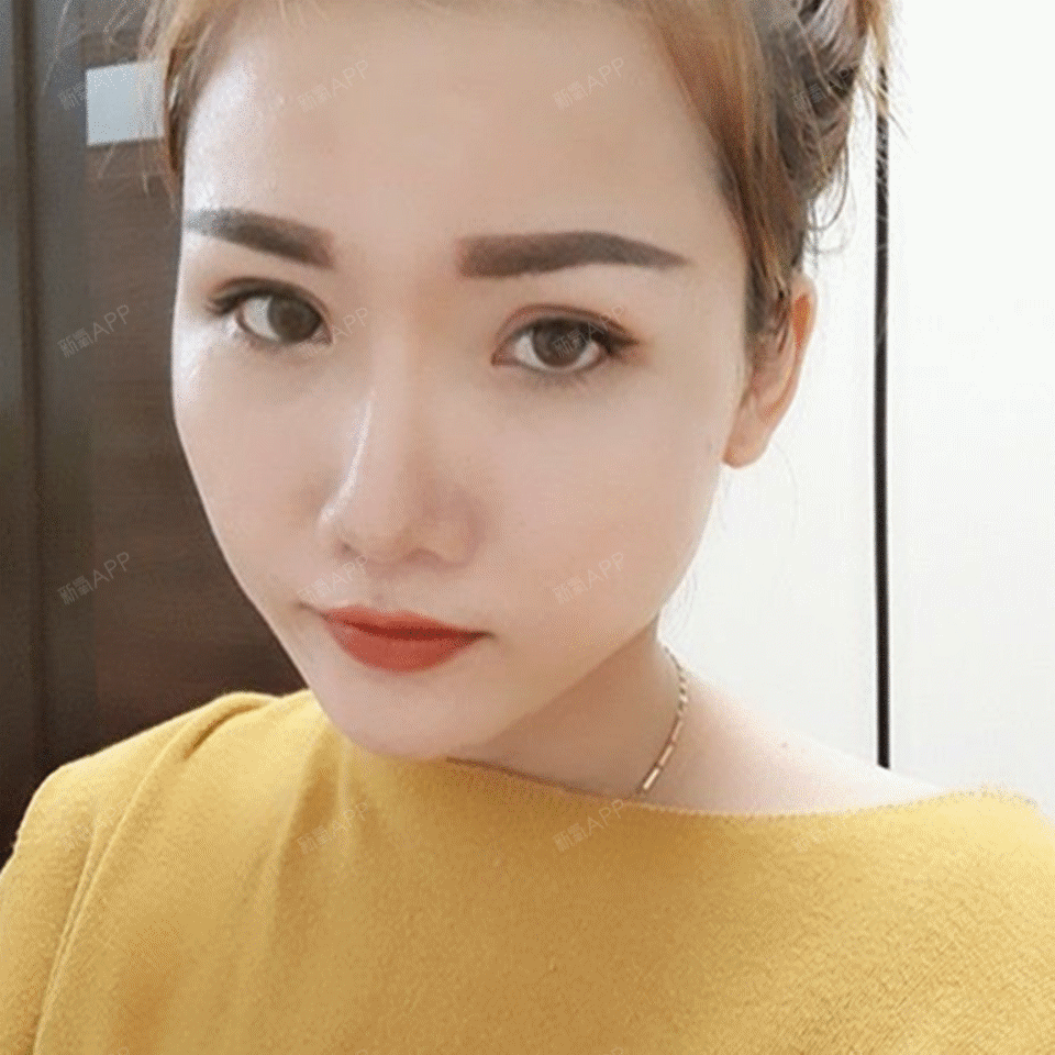 【扬州美贝尔●六度美眼】一转眼双眼皮手术已经做了这么久了,我都快