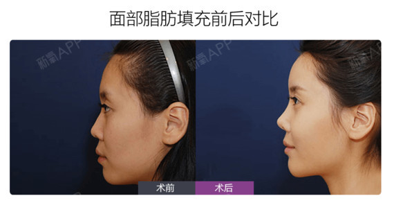 面部脂肪填充，是永久的吗?在现代社会，人们以瘦为美，瘦瘦的脸型也大受人们_圈子-新氧美容整形