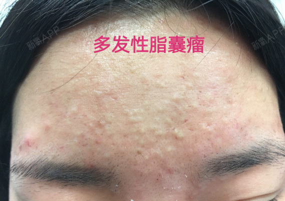 严重的白头粉刺:角质层有够厚,皮脂越积越多,就形成这样的"多发性脂囊
