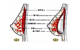 3乳房下皱襞切口