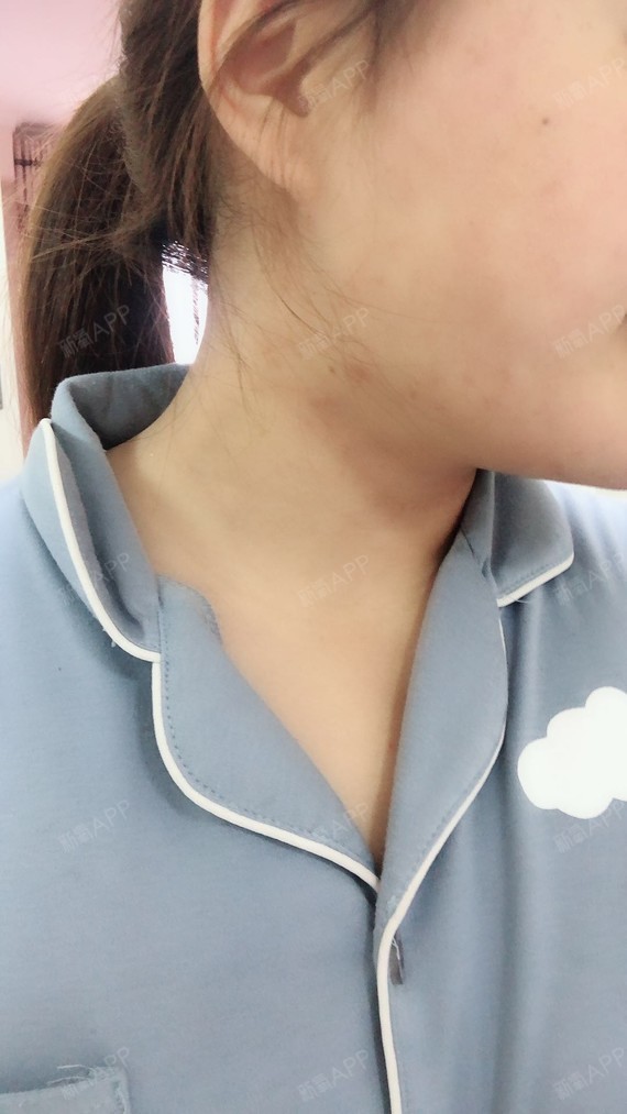 xiabing吸脂瘦手臂第11天美丽日记-新氧美容整