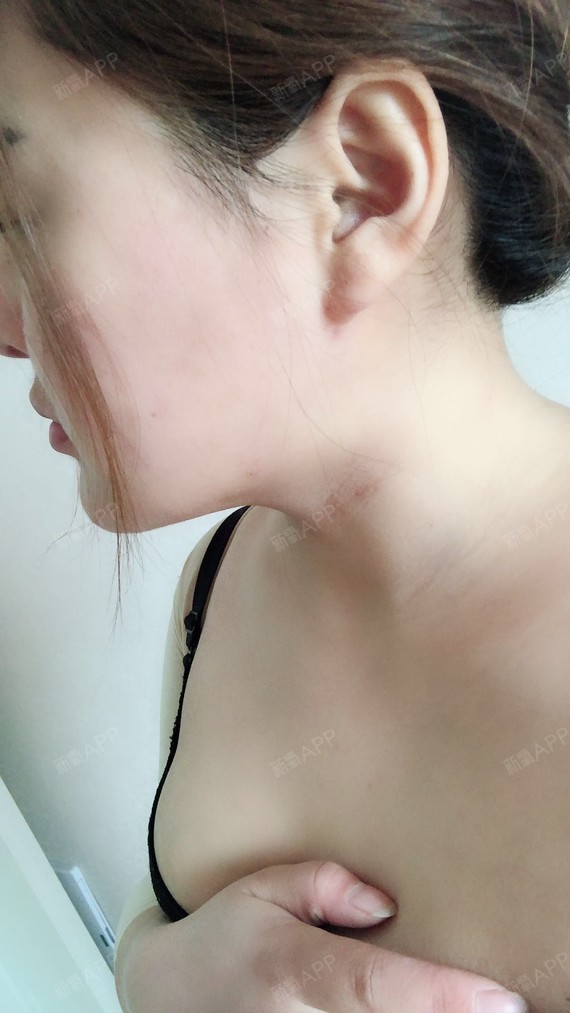 xiabing吸脂瘦手臂第11天美丽日记-新氧美容整