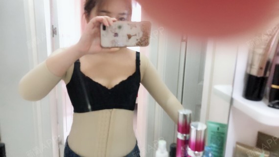 xiabing吸脂瘦手臂第11天美丽日记-新氧美容整