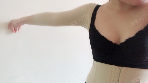 xiabing吸脂瘦手臂第11天美丽日记-新氧美容整