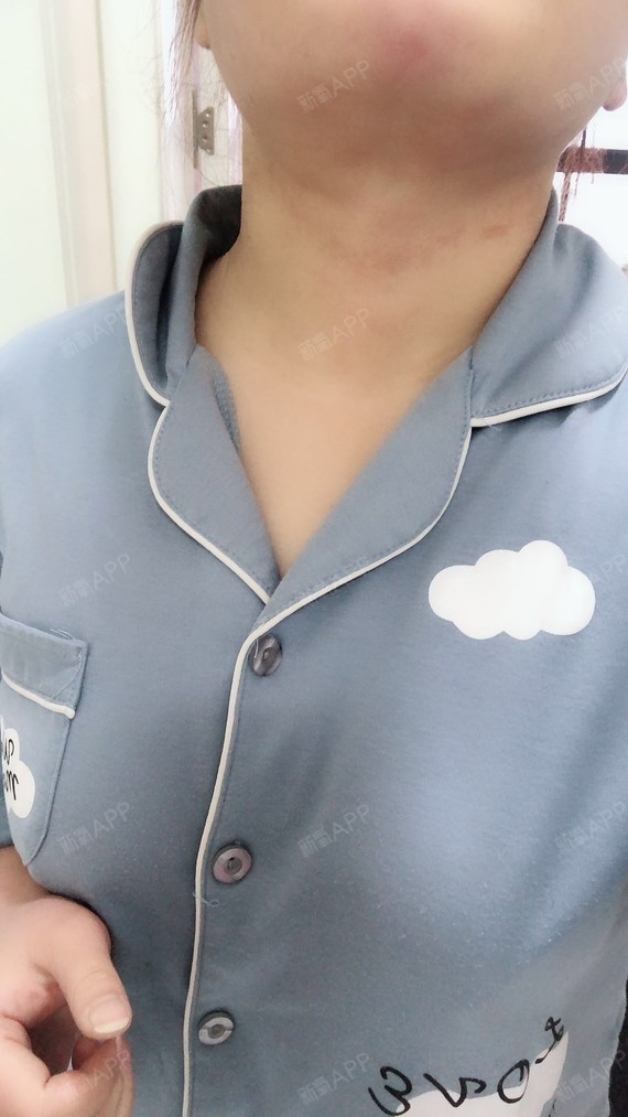 xiabing吸脂瘦手臂第11天美丽日记-新氧美容整