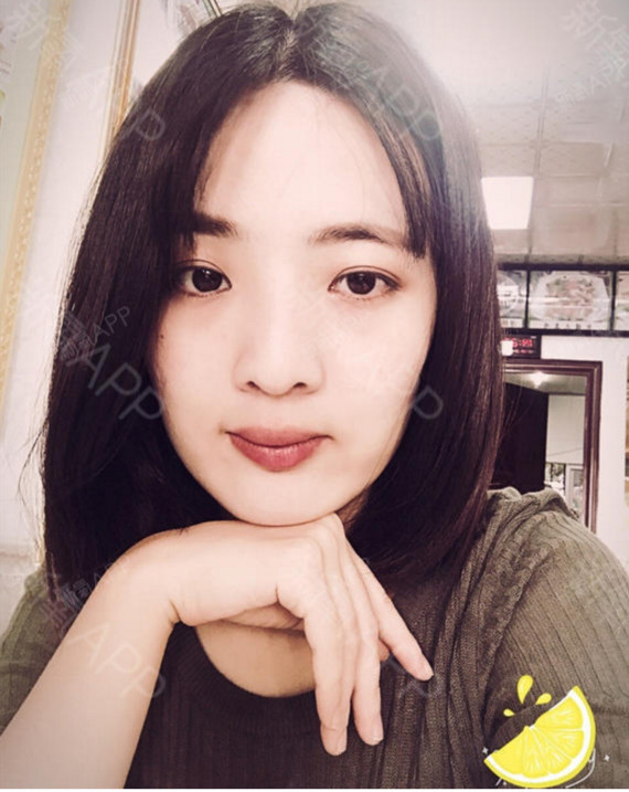 大龄牙套妹金属托槽矫正第33天美丽日记-新氧