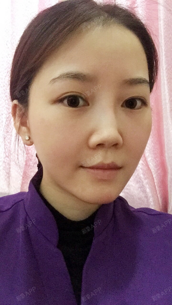 芝士千层橙橙自体脂肪全脸填充第7天美丽日记